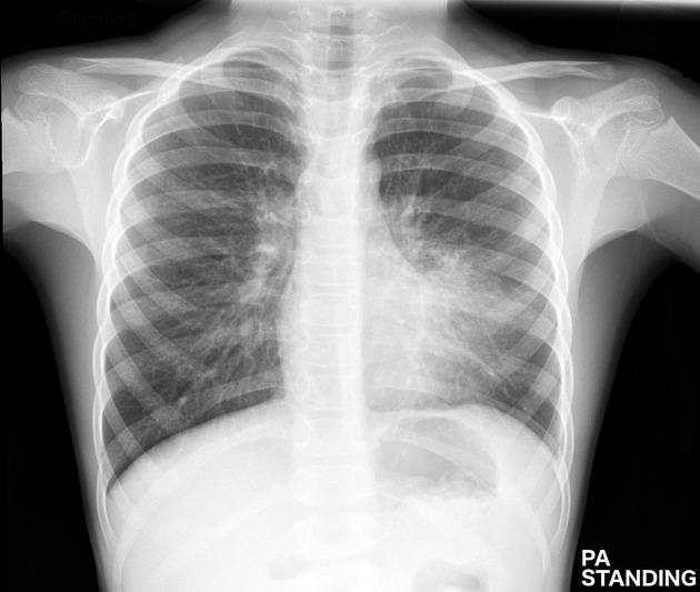 Sample pediatric chest X-ray